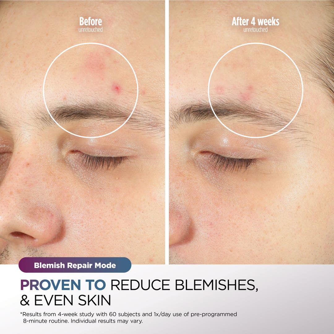 Shark CryoGlow — developed with dermatologists
